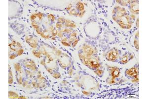 Formalin-fixed and paraffin embedded human gastric carcinoma labeled with Anti YES1 Polyclonal Antibody, Unconjugated (ABIN754798) at 1:200 followed by conjugation to the secondary antibody and DAB staining (YES1 antibody  (AA 441-541))