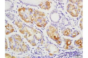 Formalin-fixed and paraffin embedded human gastric carcinoma labeled with Anti YES1 Polyclonal Antibody, Unconjugated (ABIN754798) at 1:200 followed by conjugation to the secondary antibody and DAB staining (YES1 antibody  (AA 441-541))