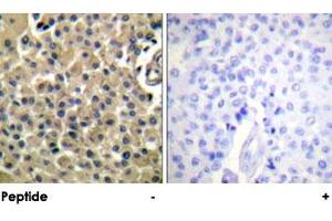 Immunohistochemical analysis of paraffin-embedded human breast carcinoma tissue using MUC1 polyclonal antibody . (MUC1 antibody)