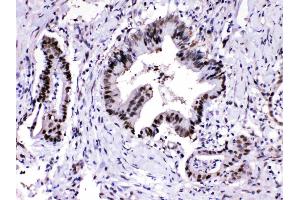 PSMA3 was detected in paraffin-embedded sections of human intetsinal cancer tissues using rabbit anti- PSMA3 Antigen Affinity purified polyclonal antibody (Catalog # ) at 1 ?