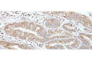 Immunohistochemistry of paraffin-embedded Human liver cancer tissue using USO1 Polyclonal Antibody at dilution of 1:30(x200) (USO1 antibody)