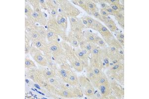 Immunohistochemistry of paraffin-embedded human liver cancer using PON1 antibody (ABIN5975112) at dilution of 1/100 (40x lens). (PON1 antibody)