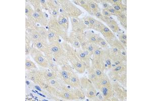 Immunohistochemistry of paraffin-embedded human liver cancer using PON1 antibody (ABIN5975112) at dilution of 1/100 (40x lens). (PON1 antibody)