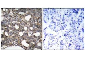 Immunohistochemical analysis of paraffin-embedded human breast carcinoma tissue, using Connexin43 (Ab-367) antibody (E021250). (Connexin 43/GJA1 antibody)