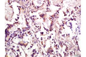 Formalin-fixed and paraffin embedded human gastric cancer labeled with Anti-phospho-PP2A alpha+beta(Tyr307) Polyclonal Antibody, Unconjugated (ABIN872299) at 1:200 followed by conjugation to the secondary antibody and DAB staining