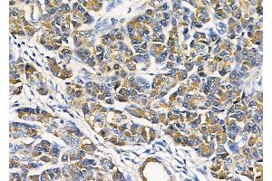 ABIN6264321 and ABIN6278365 at 1/100 staining Human pancreatic cancer and adjacent non-tumor tissue by IHC-P.