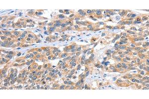 Immunohistochemistry of paraffin-embedded Human esophagus cancer tissue using CGB Polyclonal Antibody at dilution 1:60 (CGB antibody)