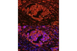 Immunofluorescence analysis of human lung cancer using  Rabbit pAb (ABIN3016195, ABIN3016196, ABIN3016197, ABIN1678542 and ABIN6219616) at dilution of 1:100 (40x lens). (ACP5 antibody  (AA 76-325))