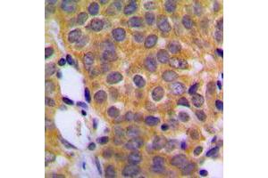 Immunohistochemical analysis of DUSP1 staining in human prostate cancer formalin fixed paraffin embedded tissue section. (DUSP1 antibody  (C-Term))