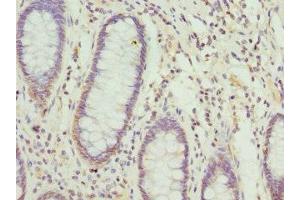 Immunohistochemistry of paraffin-embedded human colon cancer using ABIN7149015 at dilution of 1:100 (NFS1 antibody  (AA 208-457))
