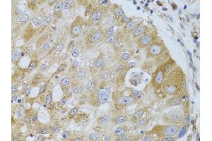 Immunohistochemistry of paraffin-embedded human breast cancer using HDAC8 antibody (ABIN5973443) at dilution of 1/100 (40x lens). (HDAC8 antibody)