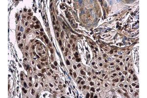 IHC-P Image NuMA antibody [N1], N-term detects NuMA protein at nucleus in human esophageal cancer by immunohistochemical analysis. (NUMA1 antibody  (N-Term))