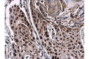 IHC-P Image NuMA antibody [N1], N-term detects NuMA protein at nucleus in human esophageal cancer by immunohistochemical analysis.