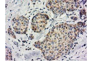 Immunohistochemical staining of paraffin-embedded Adenocarcinoma of Human breast tissue using anti-BECN1 mouse monoclonal antibody. (Beclin 1 antibody)