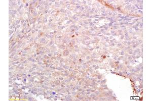 Formalin-fixed and paraffin embedded human lung carcinoma labeled with Anti-Lck/p56-LCK Polyclonal Antibody, Unconjugated (ABIN748553) at 1:200 followed by conjugation to the secondary antibody and DAB staining. (LCK antibody  (AA 421-509))