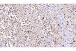 ABIN6273312 at 1/100 staining Human thyroid cancer tissue by IHC-P.