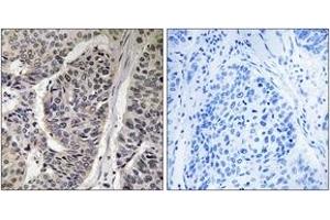 Immunohistochemistry analysis of paraffin-embedded human breast carcinoma, using p130 Cas (Phospho-Tyr410) Antibody. (BCAR1 antibody  (pTyr410))