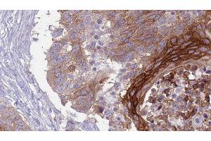 ABIN6277039 at 1/100 staining Human urothelial cancer tissue by IHC-P. (SLAMF1 antibody  (C-Term))
