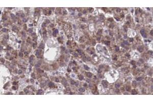 ABIN6273894 at 1/100 staining Human liver cancer tissue by IHC-P. (NPBWR2 antibody)