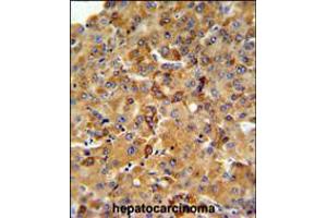SFT2D3 Antibody IHC analysis in formalin fixed and paraffin embedded human hepatocarcinoma followed by peroxidase conjugation of the secondary antibody and DAB staining. (SFT2D3 antibody  (N-Term))