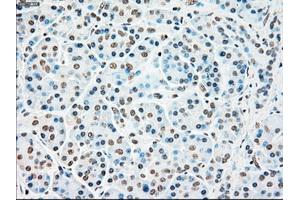 Immunohistochemical staining of paraffin-embedded Adenocarcinoma of colon tissue using anti-STK3mouse monoclonal antibody. (STK3 antibody)