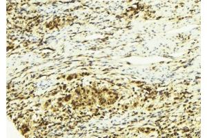 ABIN6278766 at 1/100 staining Human breast cancer tissue by IHC-P. (ZFPM2 antibody  (C-Term))