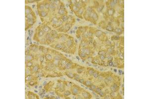 Immunohistochemistry of paraffin-embedded human liver cancer using MAOA antibody. (Monoamine Oxidase A antibody  (AA 1-260))