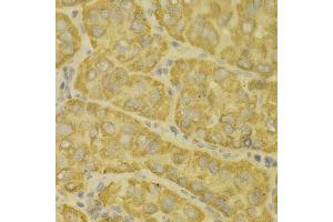 Immunohistochemistry of paraffin-embedded human liver cancer using MAOA antibody.