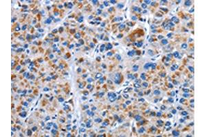 The image on the left is immunohistochemistry of paraffin-embedded Human liver cancer tissue using ABIN7128906(CENPJ Antibody) at dilution 1/40, on the right is treated with fusion protein. (CENPJ antibody)