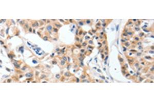Immunohistochemistry of paraffin-embedded Human lung cancer tissue using P2RY6 Polyclonal Antibody at dilution of 1:40(x200) (P2RY6 antibody)