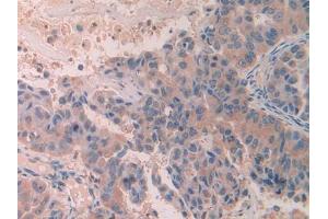 DAB staining on IHC-P; Samples: Human Breast cancer Tissue (SCUBE3 antibody  (AA 807-993))