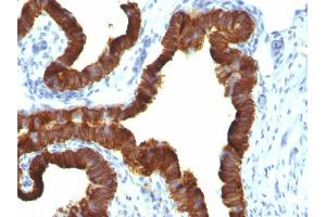 Formalin-fixed, paraffin-embedded human Ovarian Carcinoma stained with Cytokeratin 7 Mouse Monoclonal Antibody (KRT7/1198).