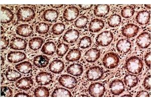 Immunohistochemistry of paraffin-embedded Human colon carcinoma tissue using gamma Tubulin Monoclonal Antibody at dilution of 1:200. (TUBG1 antibody)