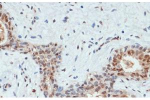 Immunohistochemistry of paraffin-embedded Human breast cancer using Phospho-AKT(S473) Polyclonal Antibody at dilution of 1:200 (40x lens). (AKT1 antibody  (pSer473))