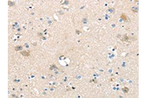 The image on the left is immunohistochemistry of paraffin-embedded Human brain tissue using ABIN7192395(SLC16A11 Antibody) at dilution 1/25, on the right is treated with synthetic peptide. (SLC16A11 antibody)