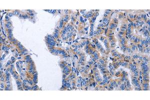 Immunohistochemistry of paraffin-embedded Human thyroid cancer tissue using BDNF Polyclonal Antibody at dilution 1:40 (BDNF antibody)