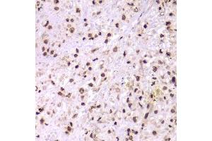 Immunohistochemistry of paraffin-embedded human adenomyosis using XRCC6 Antibody. (XRCC6 antibody  (AA 500-600))