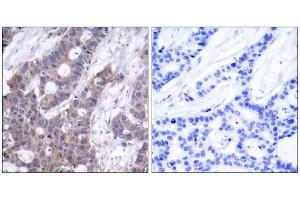 Immunohistochemical analysis of paraffin-embedded human breast carcinoma tissue, using Stathmin 1 (phospho-Ser15) antibody (E011234). (Stathmin 1 antibody  (pSer15))