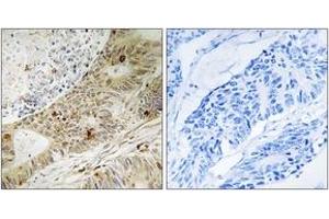 Immunohistochemistry analysis of paraffin-embedded human colon carcinoma, using ATRIP (Phospho-Ser224) Antibody. (ATRIP antibody  (pSer224))