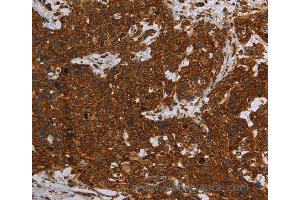 Immunohistochemistry of Human ovarian cancer using ERRFI1 Polyclonal Antibody at dilution of 1:30