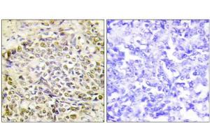 Immunohistochemistry analysis of paraffin-embedded human lung carcinoma tissue using IRX2 antibody. (IRX2 antibody  (Internal Region))