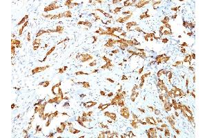 Formalin-fixed, paraffin-embedded human Breast Carcinoma stained with HSP27 Monoclonal Antibody (SPM252) (HSP27 antibody)