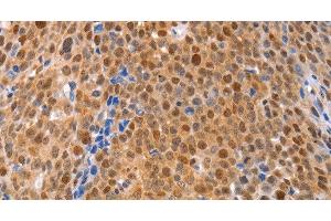 Immunohistochemistry of paraffin-embedded Human ovarian cancer using MKP-2 Polyclonal Antibody at dilution of 1:30 (DUSP4 antibody)