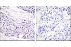 Immunohistochemistry analysis of paraffin-embedded human breast carcinoma tissue, using p90 RSK (Ab-359/363) Antibody. (RPS6KA3 antibody  (AA 331-380))