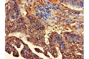 Immunohistochemistry of paraffin-embedded human colon cancer using ABIN7147936 at dilution of 1:100