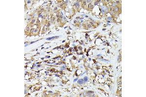 Immunohistochemistry of paraffin-embedded human esophageal cancer using ASC/TMS1 Rabbit pAb (ABIN7269756) at dilution of 1:200 (40x lens). (PYCARD antibody)
