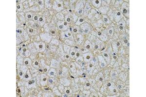 Immunohistochemistry of paraffin-embedded Human liver damage using NRF1 Polyclonal Antibody at dilution of 1:100 (40x lens).