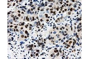 Immunohistochemical staining of paraffin-embedded Adenocarcinoma of breast tissue using anti-CISD1 mouse monoclonal antibody. (CISD1 antibody)