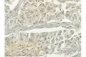 ABIN6257324 and ABIN6273467 at 1/100 staining human lung squamous cell carcinoma by IHC-P. (MLF1IP antibody  (N-Term))