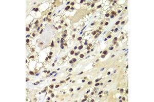 Immunohistochemistry of paraffin-embedded human kidney cancer using PRKDC antibody (ABIN5975861) at dilution of 1/100 (40x lens).